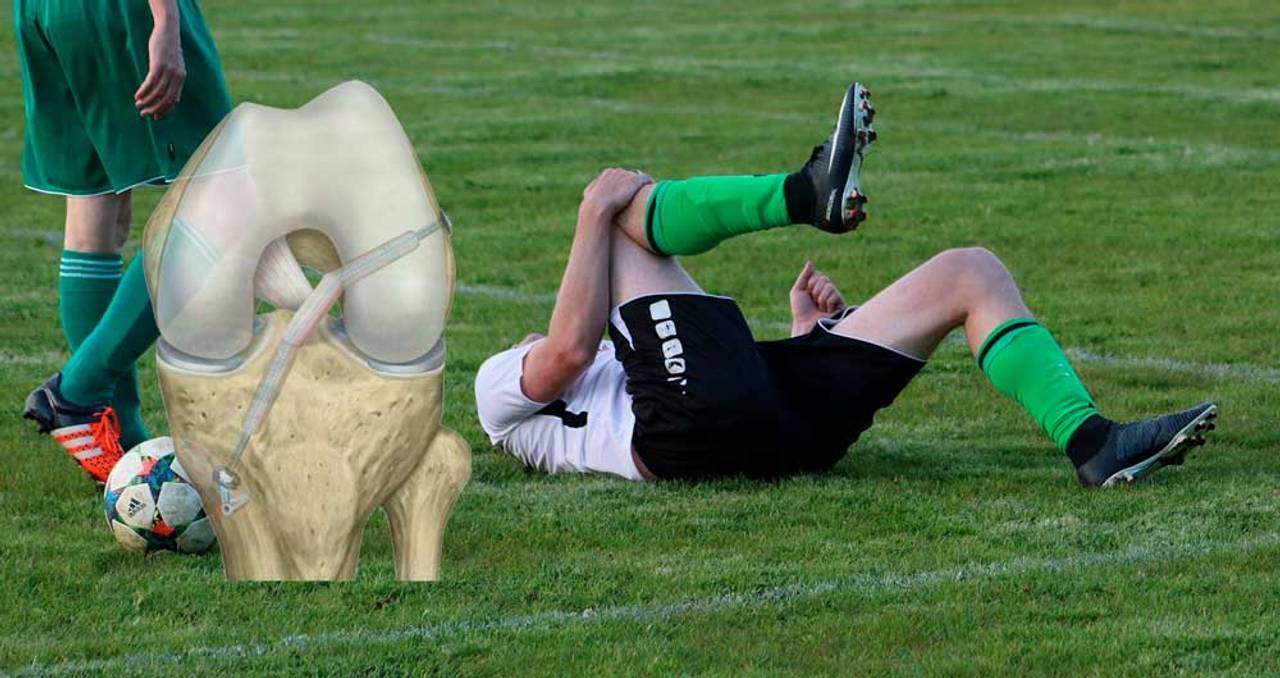 The ACL Tear Recovery Chronicles: Dispelling Myths and Navigating Recovery Phases for Soccer Enthusiasts