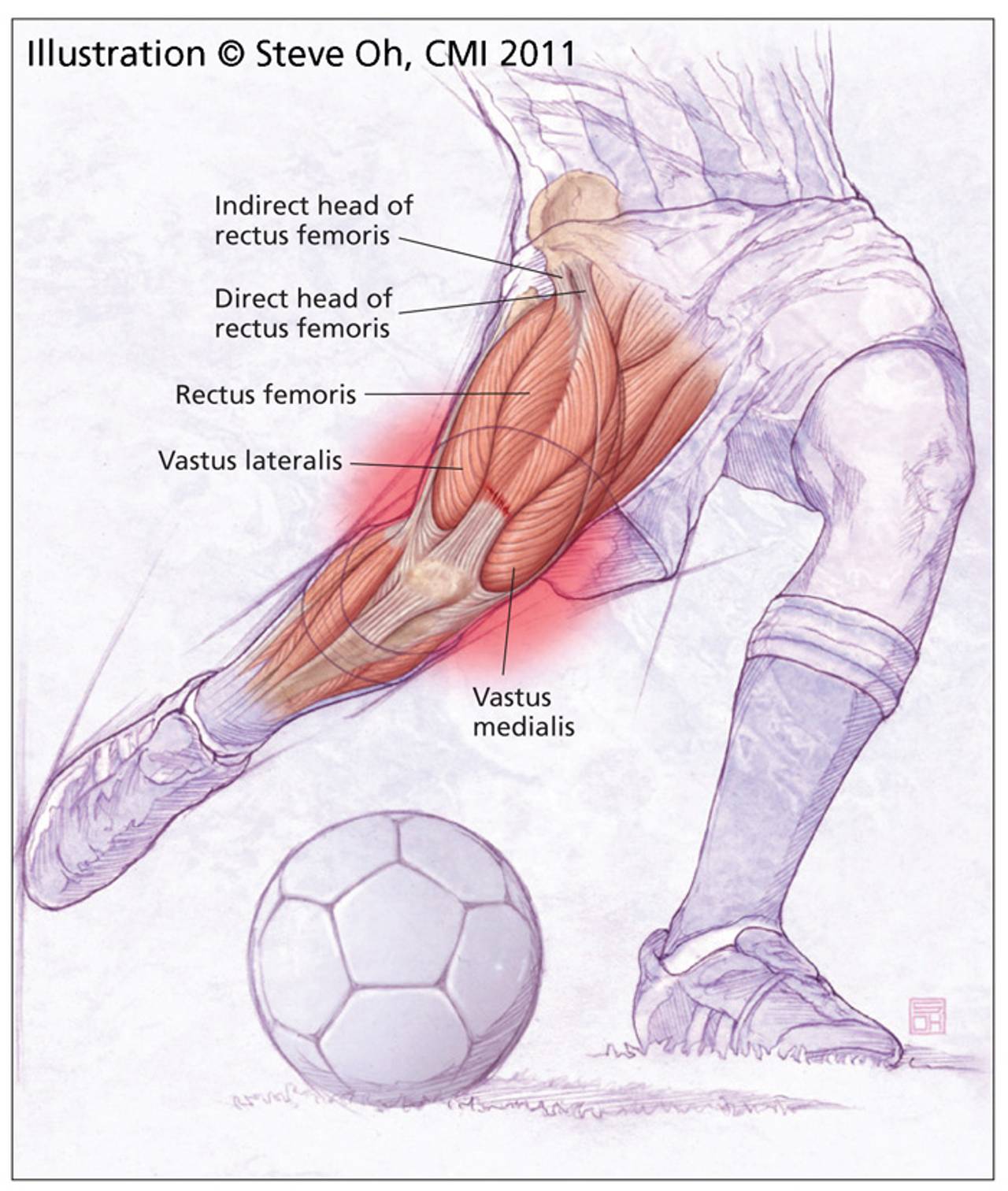 Rebounding from Hip Flexor Strains: The Road to Recovery for Soccer Players