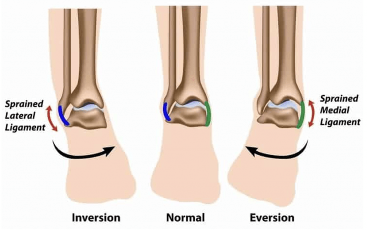 Triumph Over Twists: A Basketball Player's Journey Through Ankle Sprain Recovery