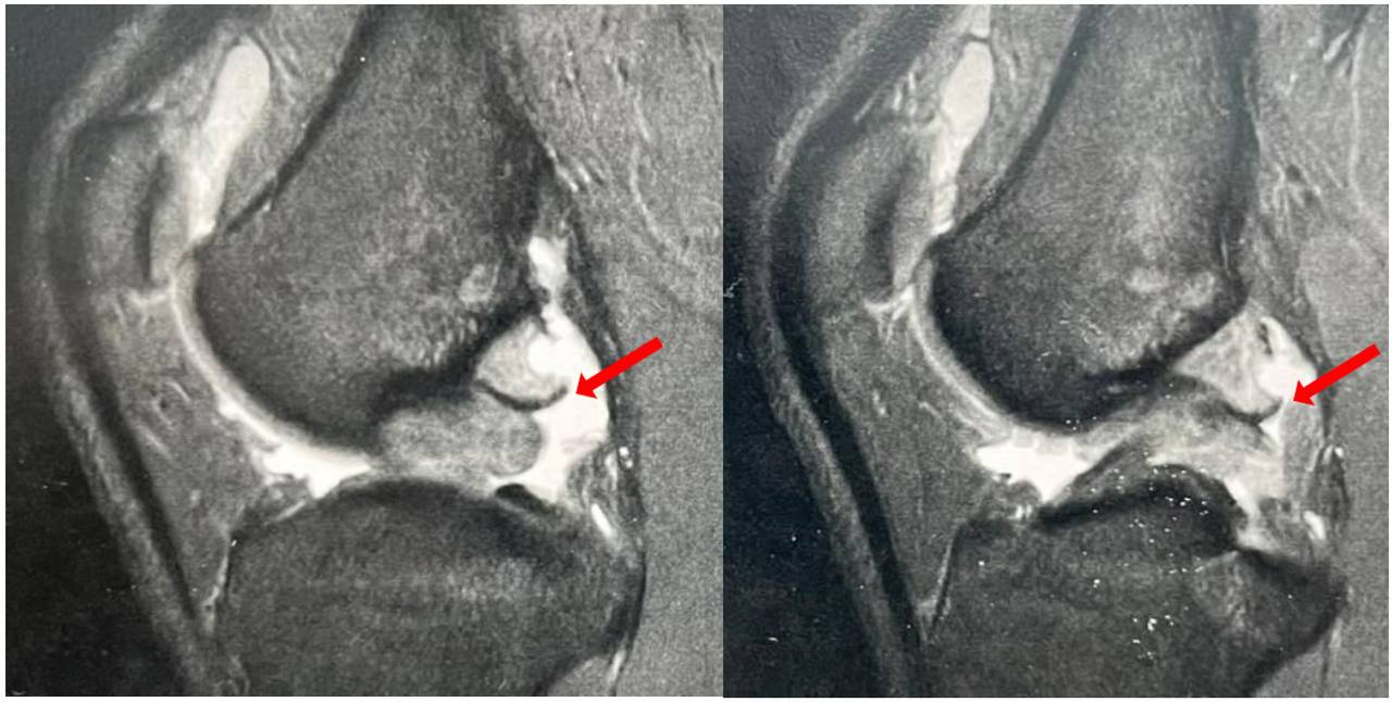 Unlocking Athletic Potential: A Biomechanical Approach to Sports Injury Recovery